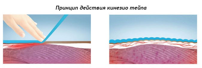 Тейпирование голеностопа: тейпы для кинезотейпирования